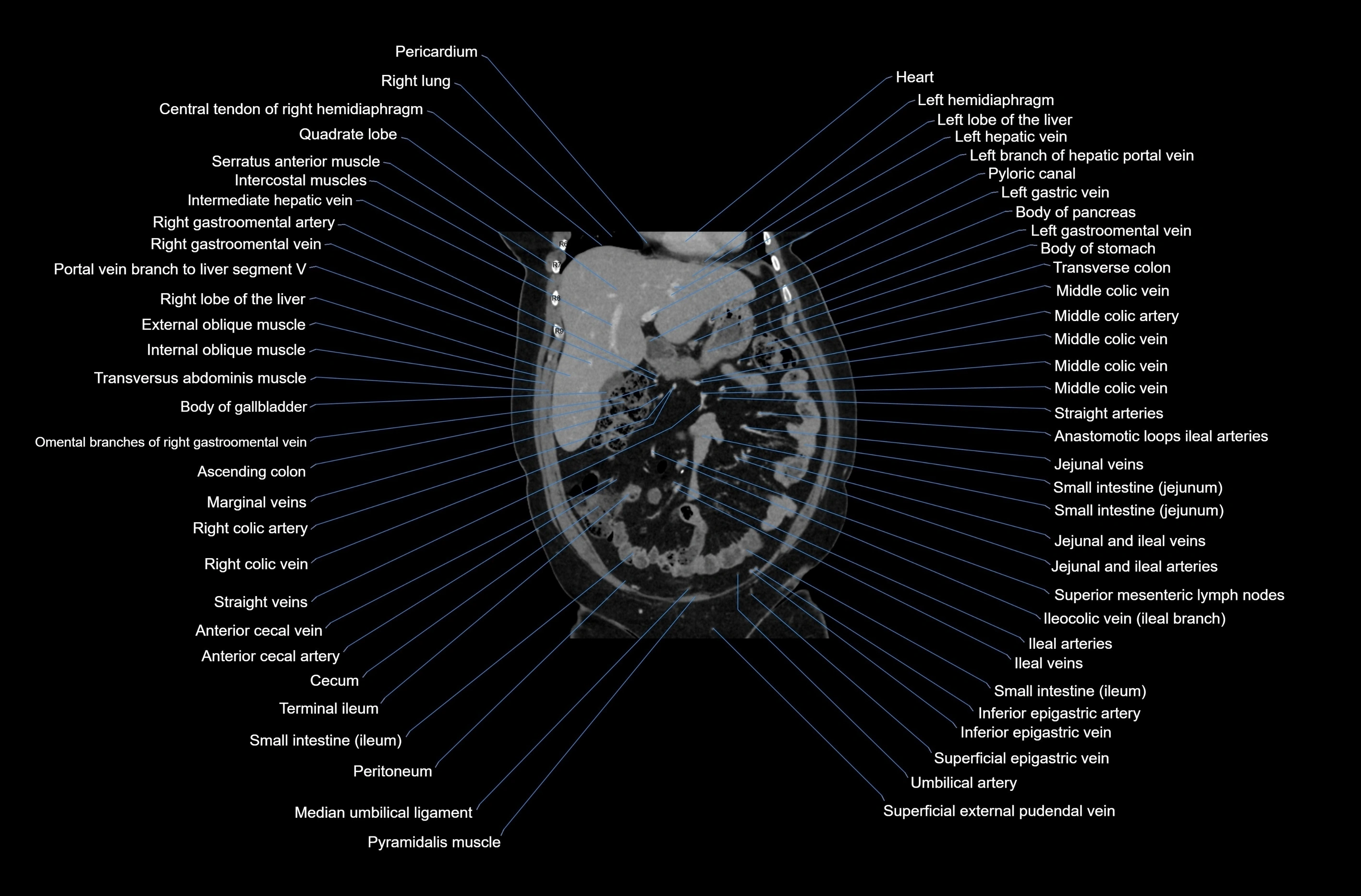 CT abdomen coronal cross sectional anatomy labelled radiology image-00027.webp